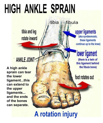 High Ankle Sprain - Dr. Allison Reid, Chiropractor